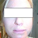 After restylane: this is as bad as the swelling got. It only felt like a duck bill for a few hours!